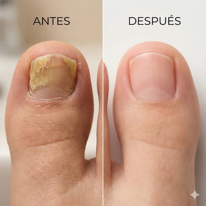 Parche Anti Hongo Uña 🦶🥺